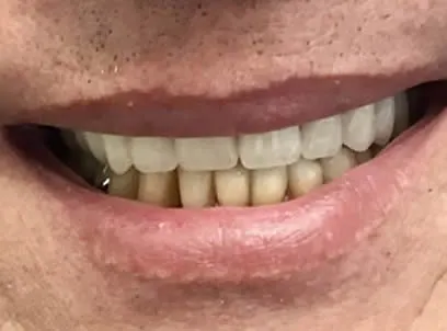 after full mouth reconstruction